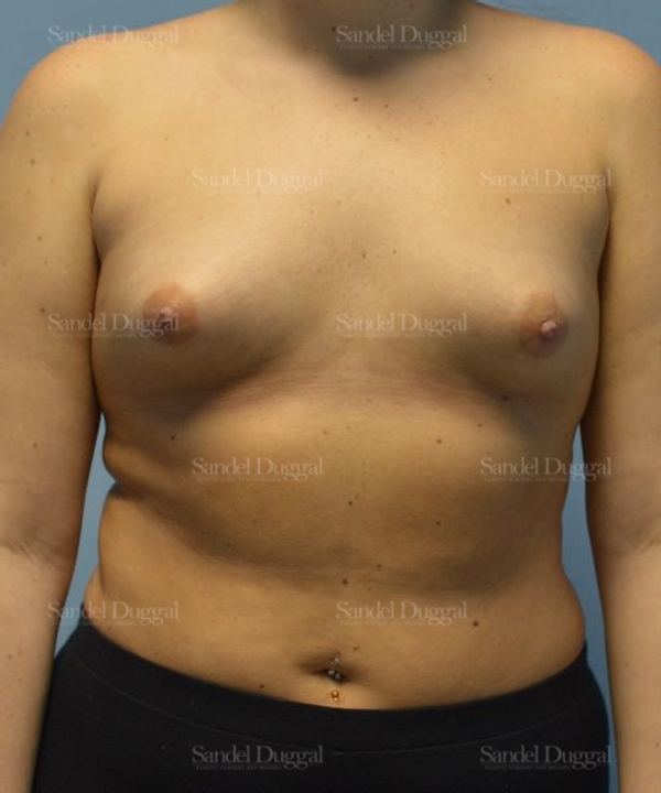 Breast Augmentation before, case 4756