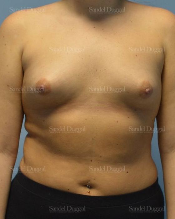Breast Augmentation before, case 4756