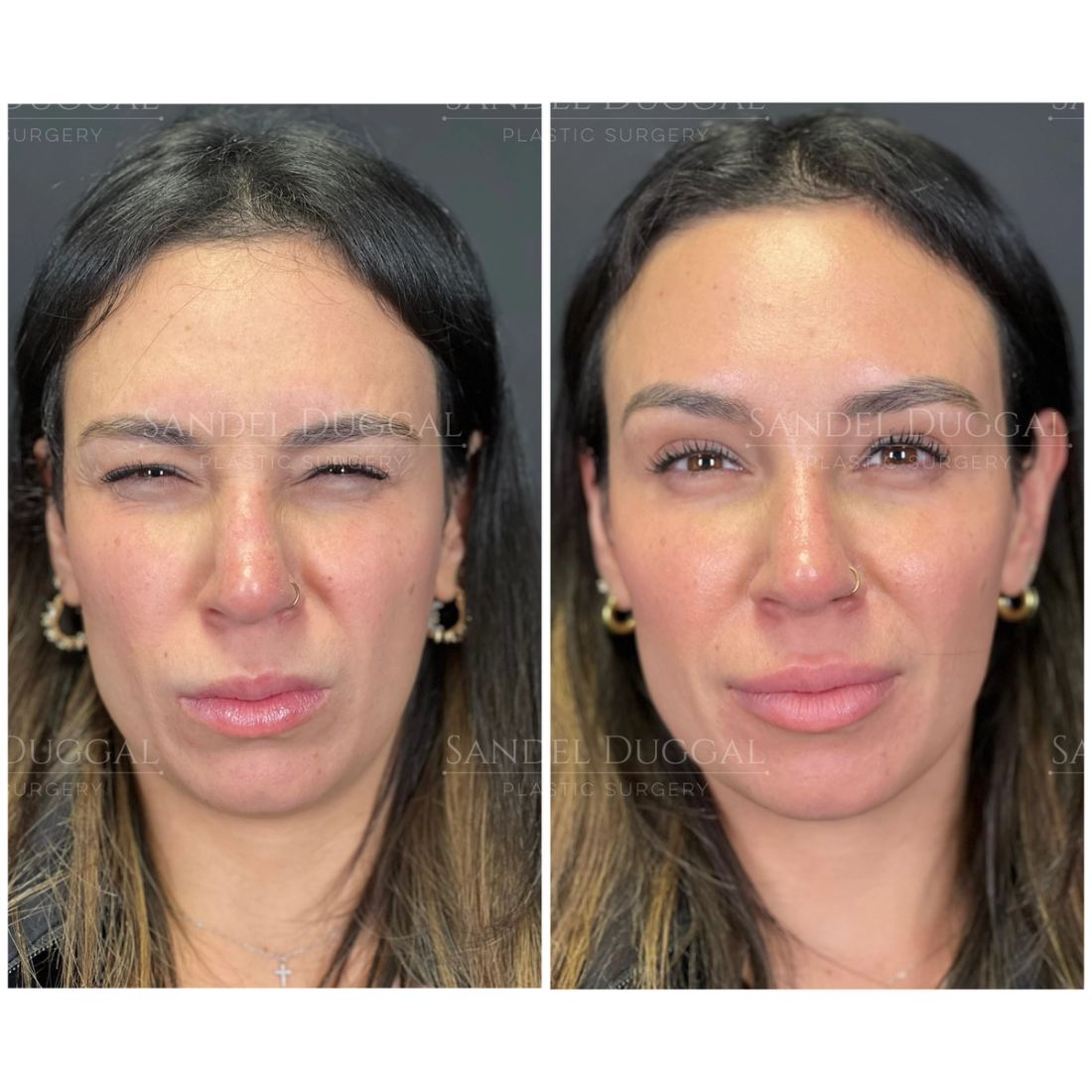 Botox & Fillers before and after, case 6013