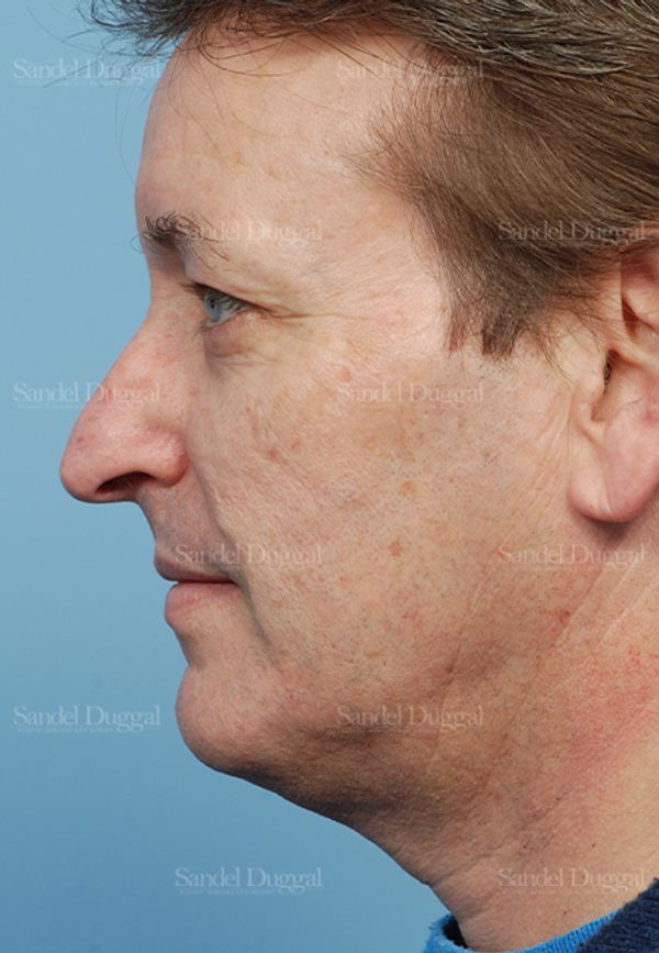 Rhinoplasty before, case 2838