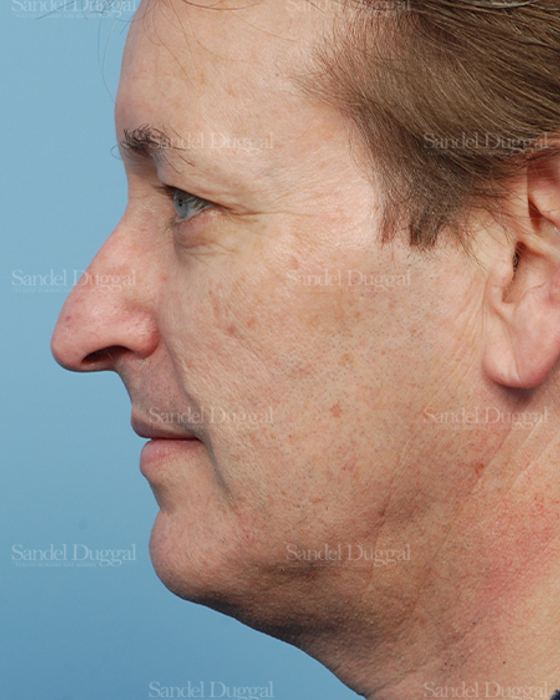 Rhinoplasty before, case 2838