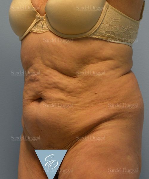 Tummy Tuck before, case 1729