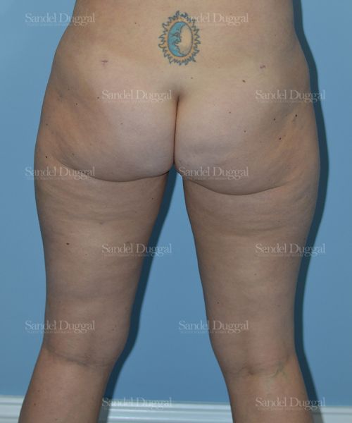 Liposuction — Legs & Flanks after, case 2532