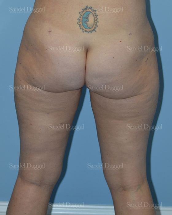 Liposuction — Legs & Flanks after, case 2532