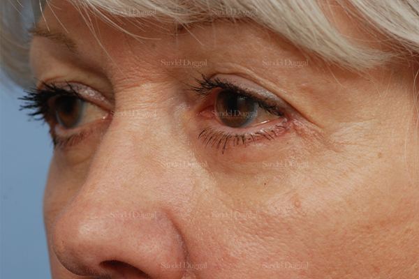 Eyelid Rejuvenation after, case 1983