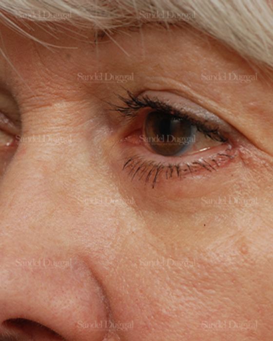 Eyelid Rejuvenation after, case 1983