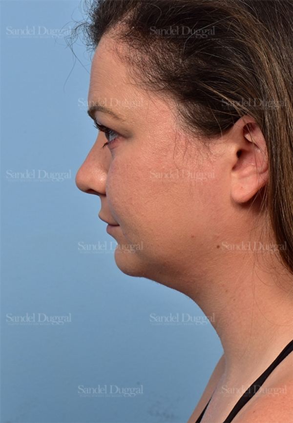 Neck & Chin Liposuction after, case 5362