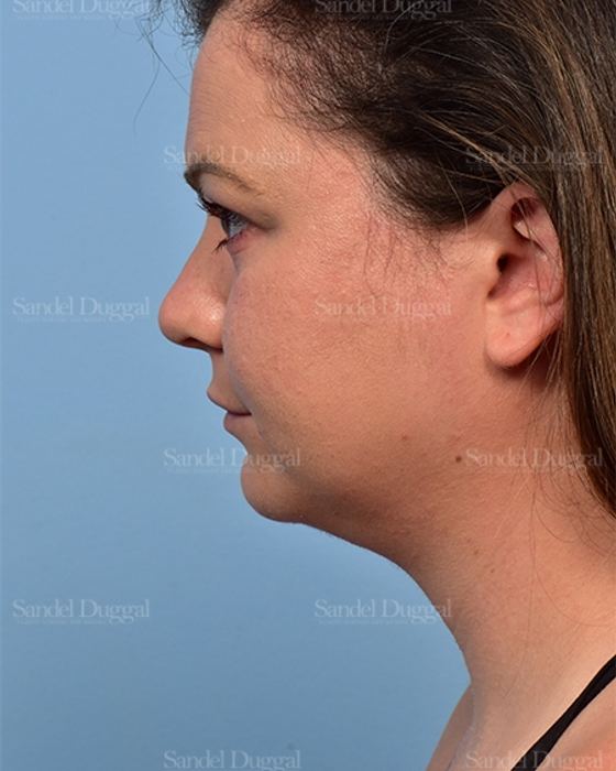 Neck & Chin Liposuction after, case 5362