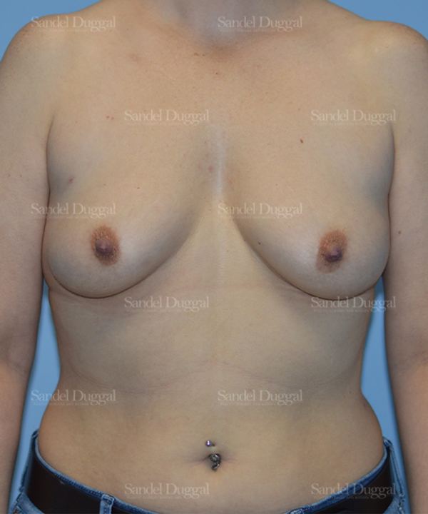 Breast Augmentation before, case 3066