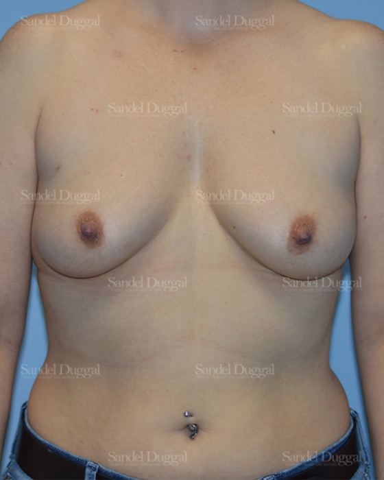 Breast Augmentation before, case 3066