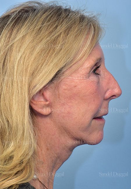 Facelift after, case 5735