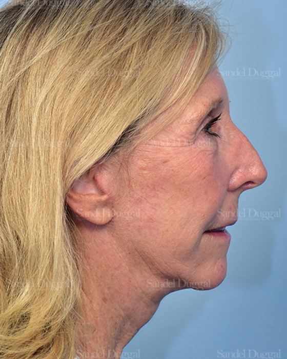 Facelift after, case 5735