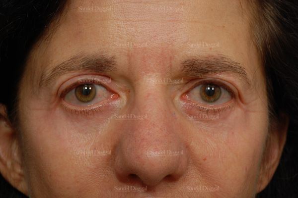 Forehead Lift after, case 2234
