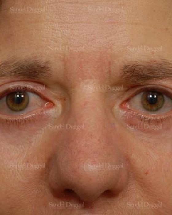 Forehead Lift after, case 2234
