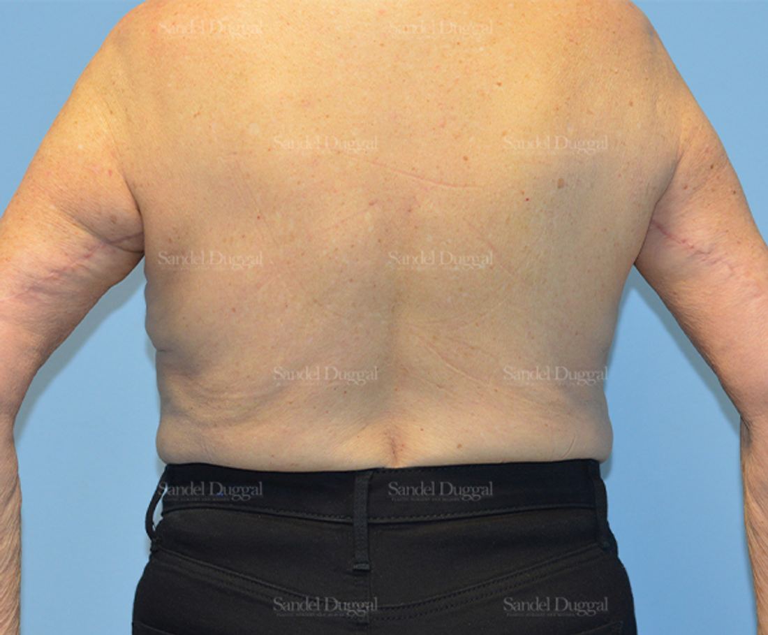 Brachioplasty before and after, case 2144