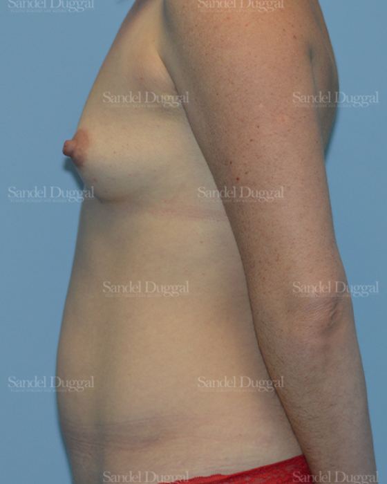 Mommy Makeover before, case 792