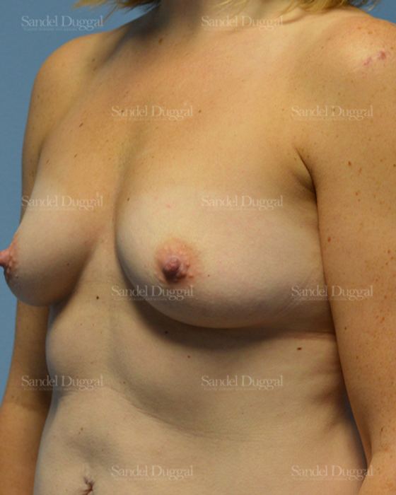 Breast Augmentation before, case 3192