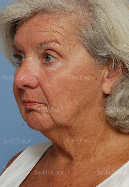 Laser Skin Resurfacing before, case 2950