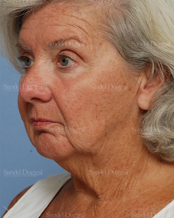 Laser Skin Resurfacing before, case 2950