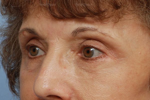 Eyelid Rejuvenation after, case 1907