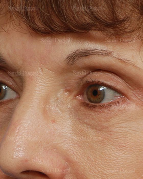 Eyelid Rejuvenation after, case 1907