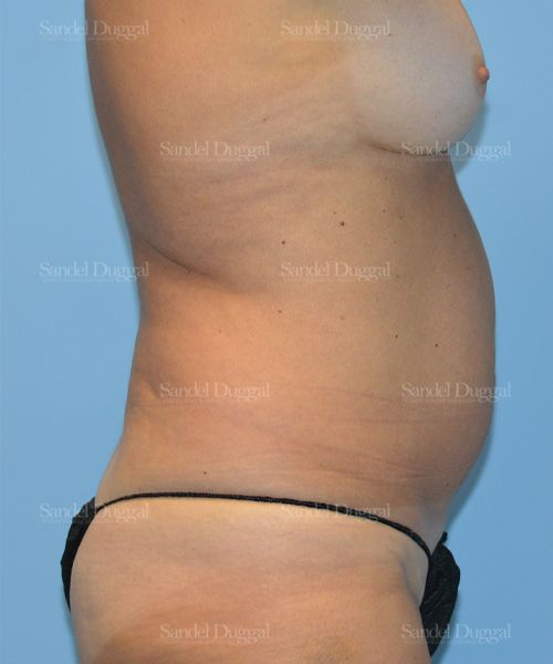 Liposuction — Abdomen before, case 2451