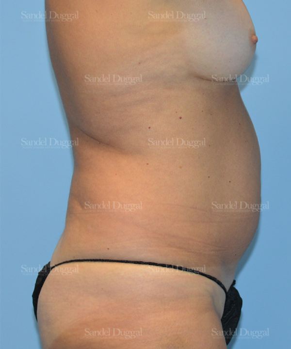 Liposuction — Abdomen before, case 2451