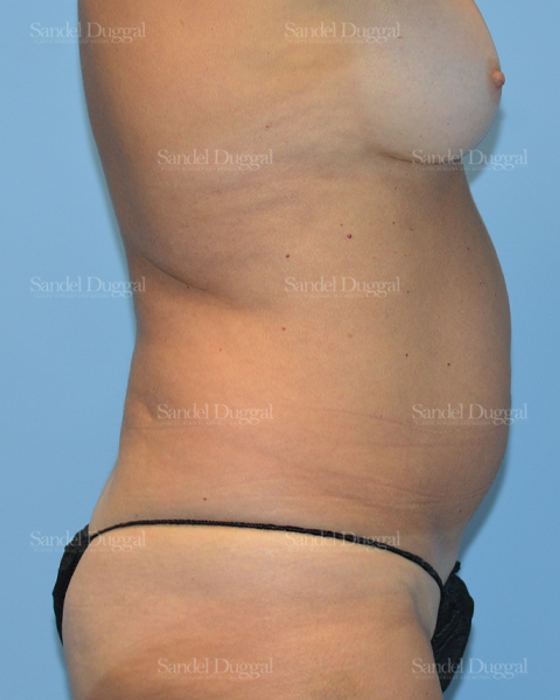 Liposuction — Abdomen before, case 2451