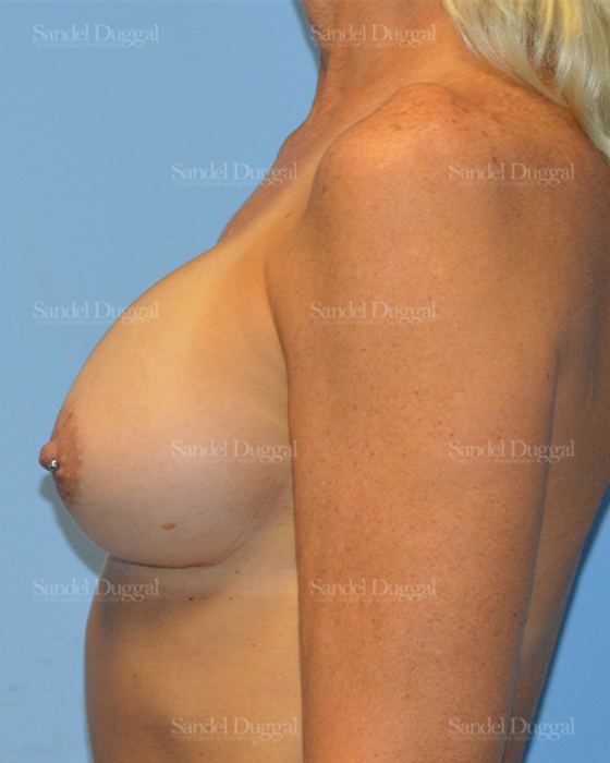 Breast Augmentation after, case 3248