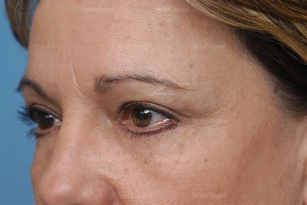 Eyelid Rejuvenation after, case 1900