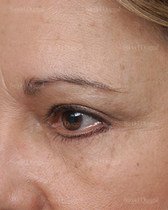 Eyelid Rejuvenation after, case 1900