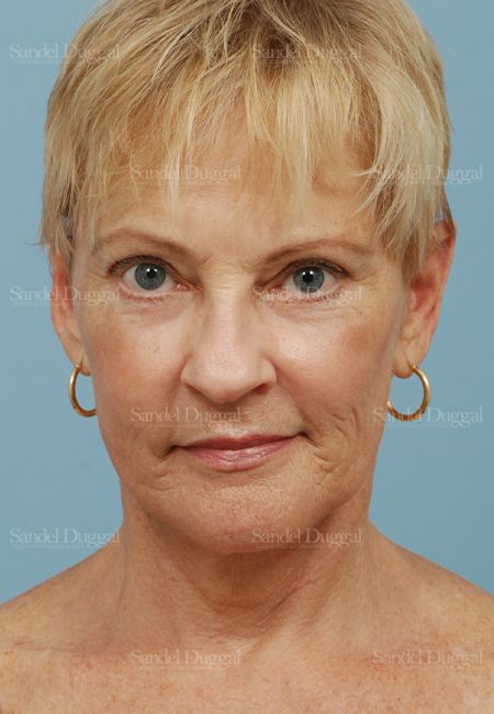 Laser Skin Resurfacing after, case 2692