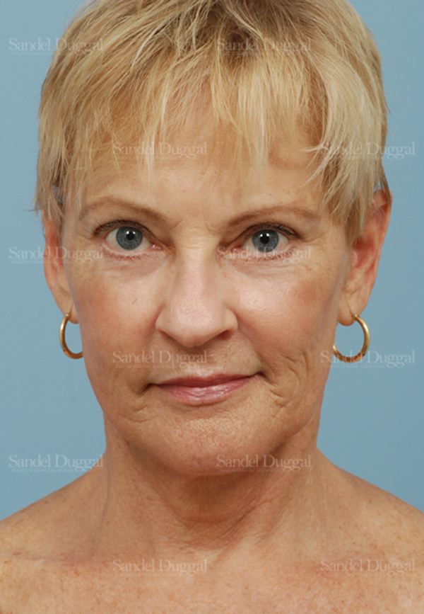 Laser Skin Resurfacing after, case 2692