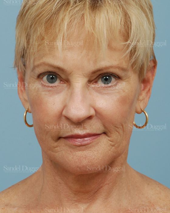 Laser Skin Resurfacing after, case 2692