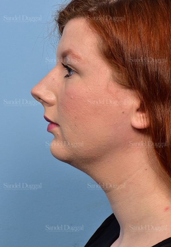Neck & Chin Liposuction before, case 5365