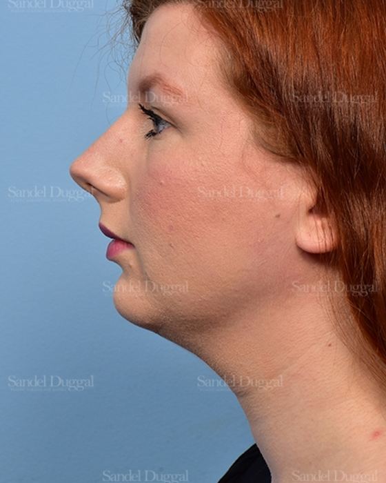 Neck & Chin Liposuction before, case 5365