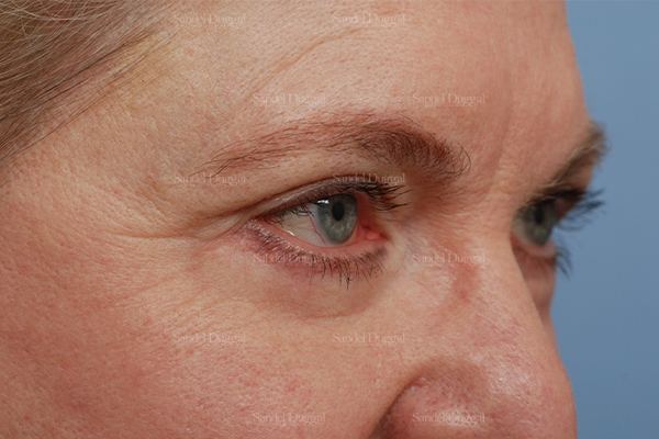 Eyelid Rejuvenation after, case 1927