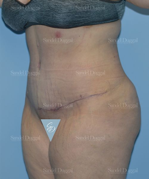 Tummy Tuck after, case 1701