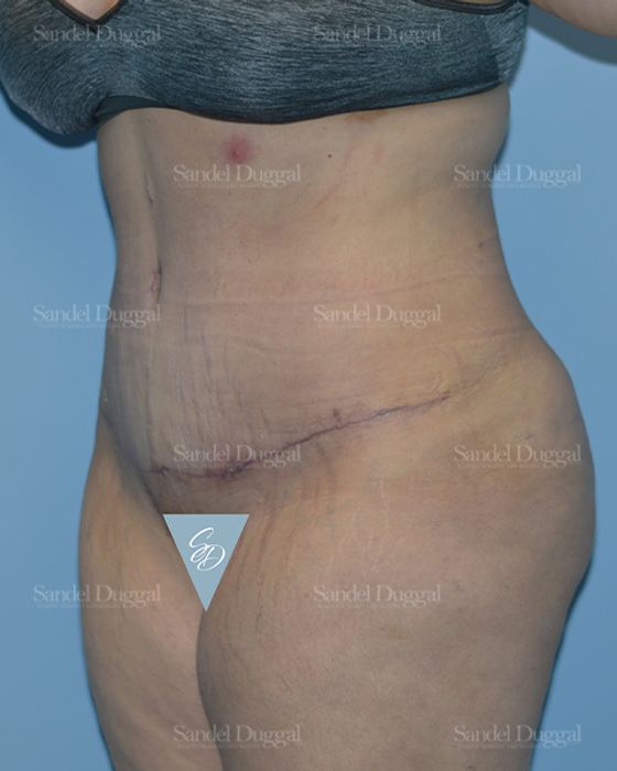 Tummy Tuck after, case 1701