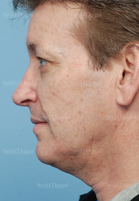 Rhinoplasty after, case 2838