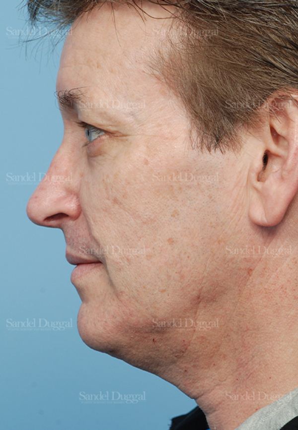 Rhinoplasty after, case 2838