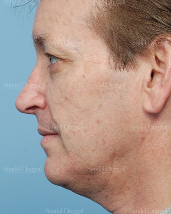 Rhinoplasty after, case 2838