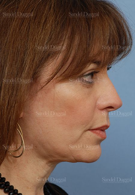 Facelift after, case 813