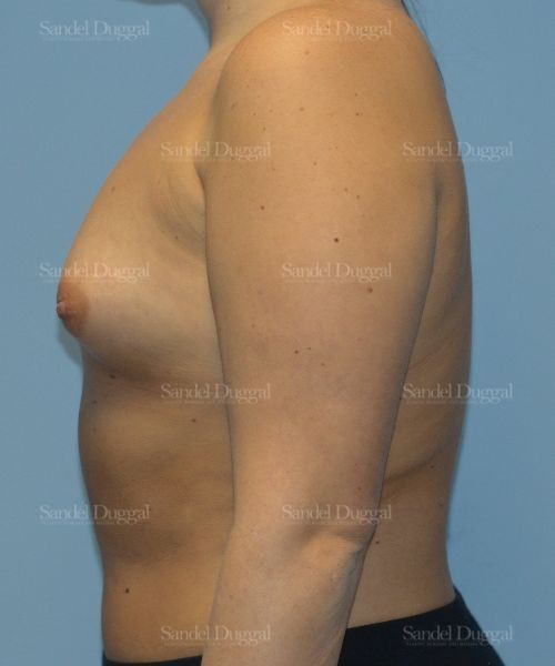 Breast Augmentation before, case 4756