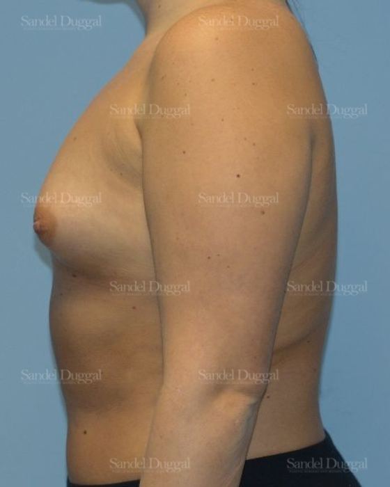 Breast Augmentation before, case 4756