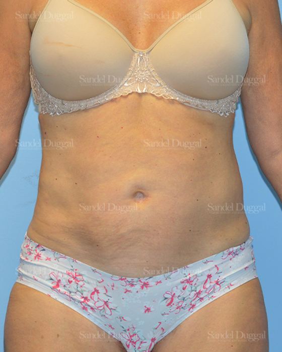Liposuction — Abdomen after, case 2451