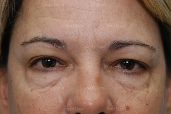 Forehead Lift before, case 2226