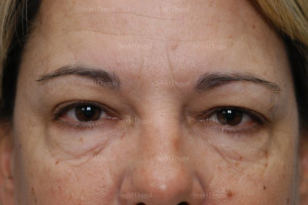 Forehead Lift before, case 2226