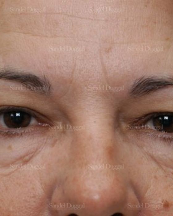 Forehead Lift before, case 2226