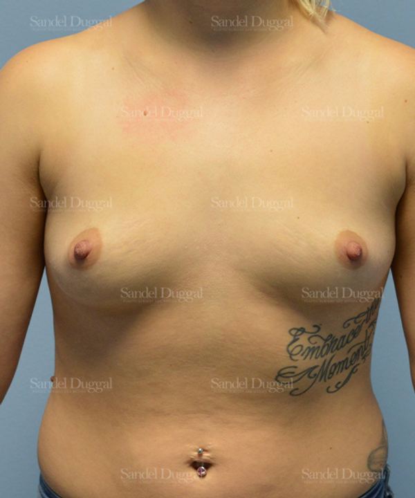 Breast Augmentation before, case 3101